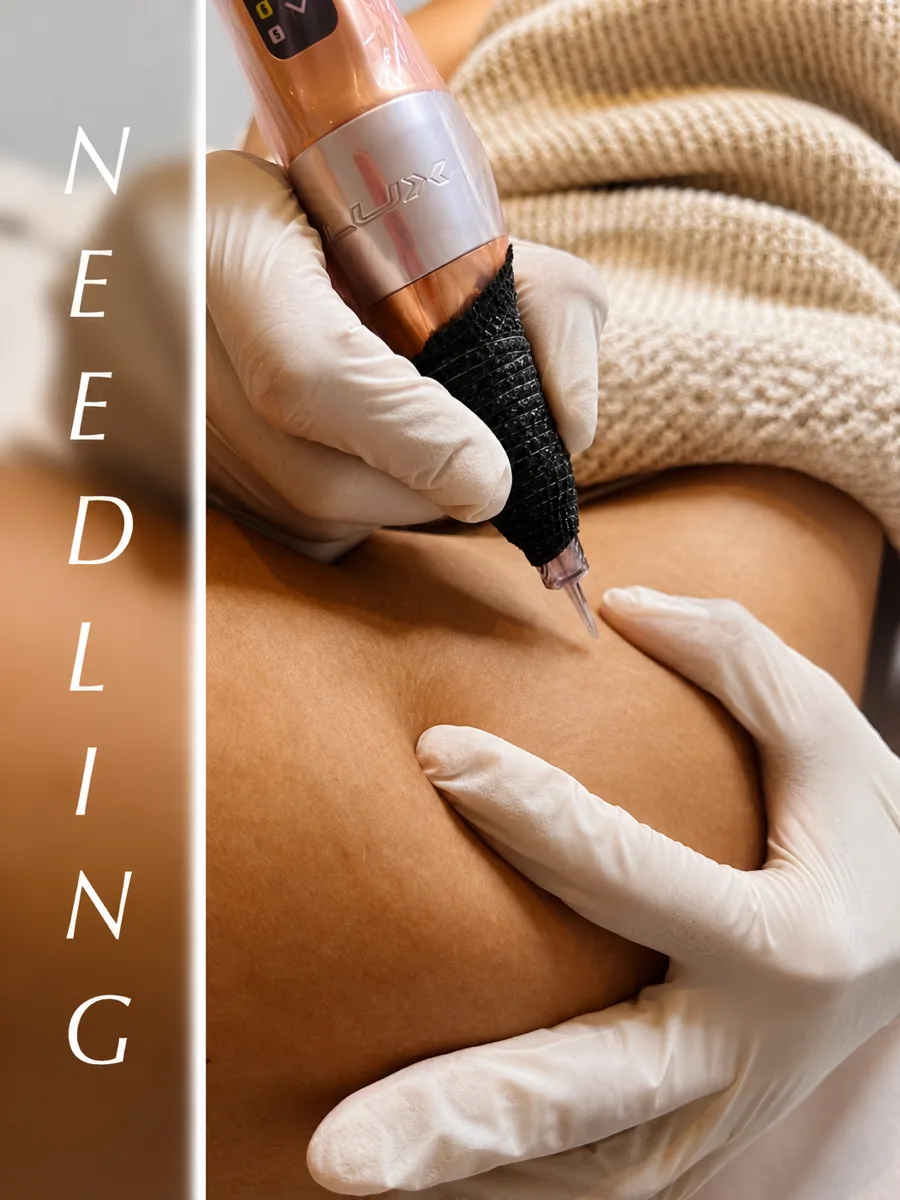 NEEDLING