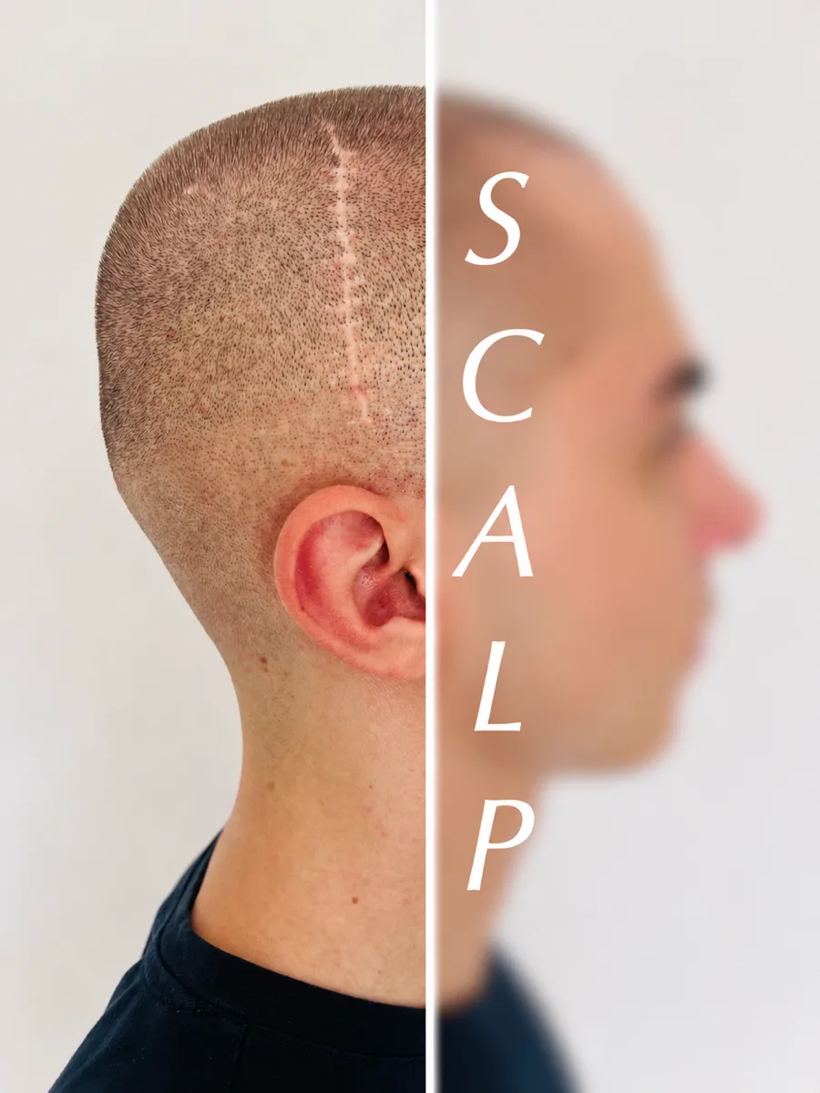 SCALP