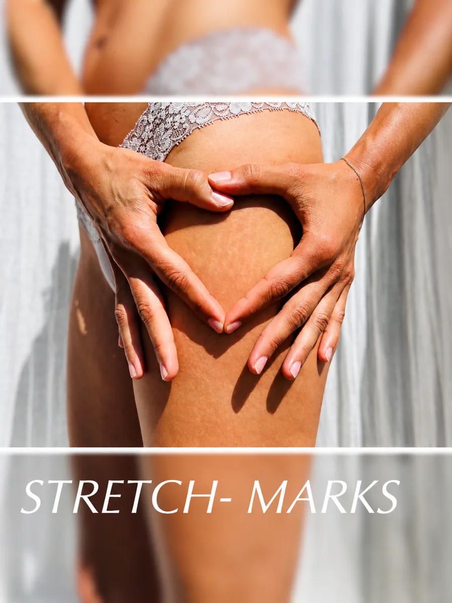 STRETCH-MARKS